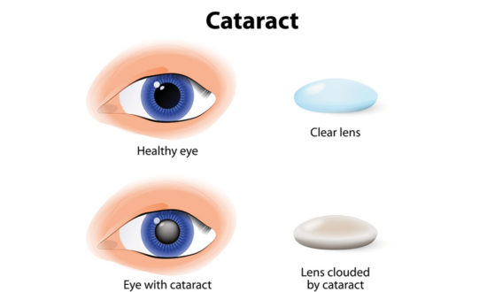 What are cataracts and how are they treated?
