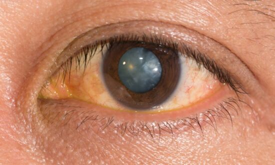 Understanding Cataracts and Their Treatment